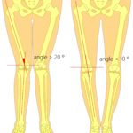 Overpronation vs supination foot knee hip back pain 2