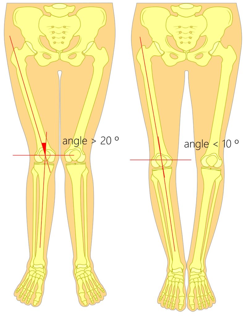 Overpronation Flat Feet Pain Treatment 10 overpronation