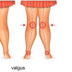 Overpronation vs underpronation foot knee hip pain 1