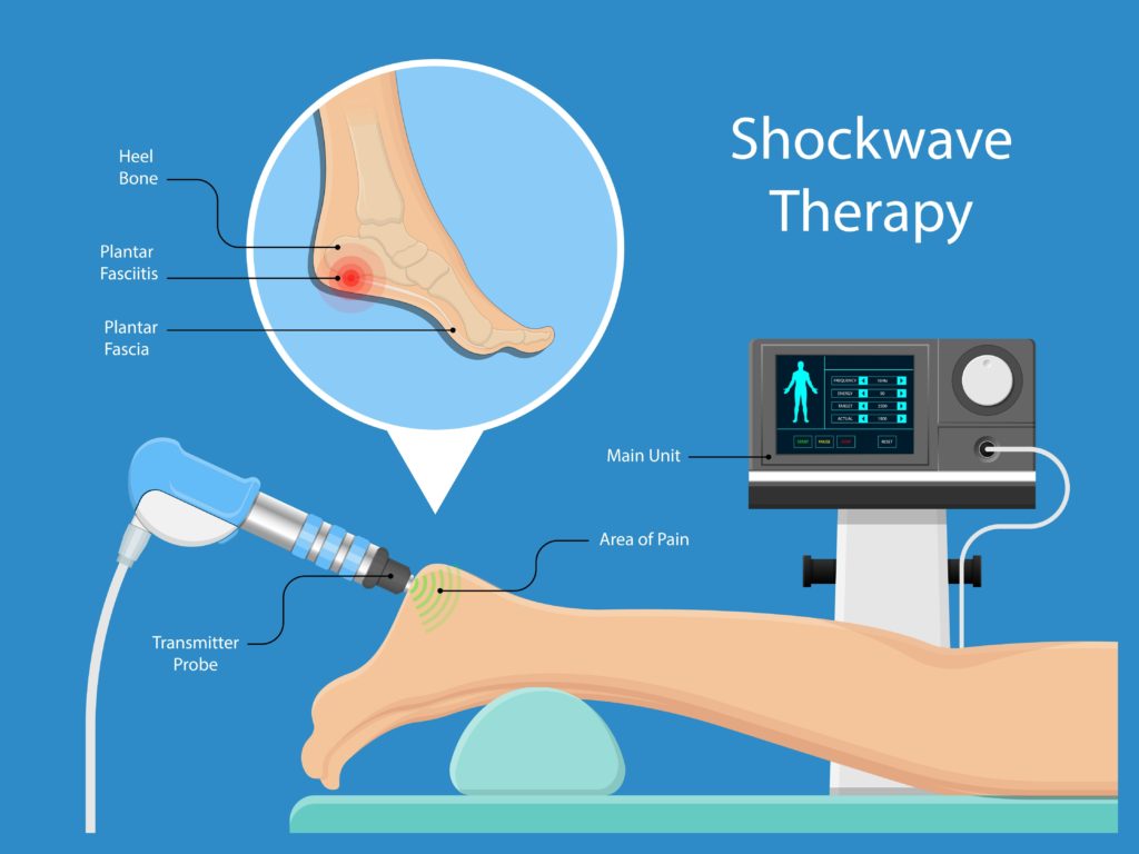 Shockwave therapy for heel spur plantar fasciitis
