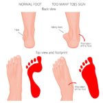 Too many toes sign overpronation 1