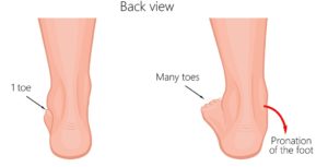 overpronation of the ankle and knee