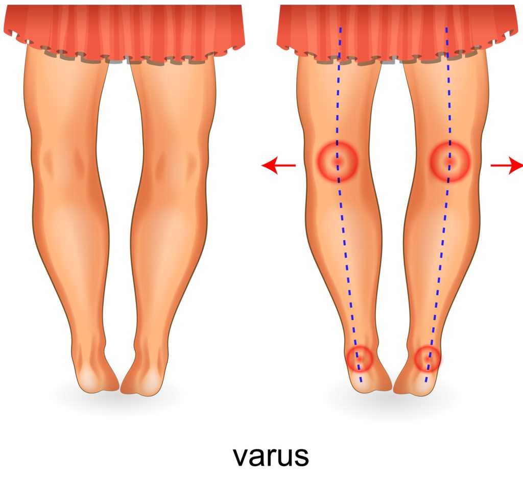 Overpronation Flat Feet Pain Treatment 12 Overpronation knee & overpronation hip pain
