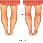 Underpronation foot knee hip pain 2