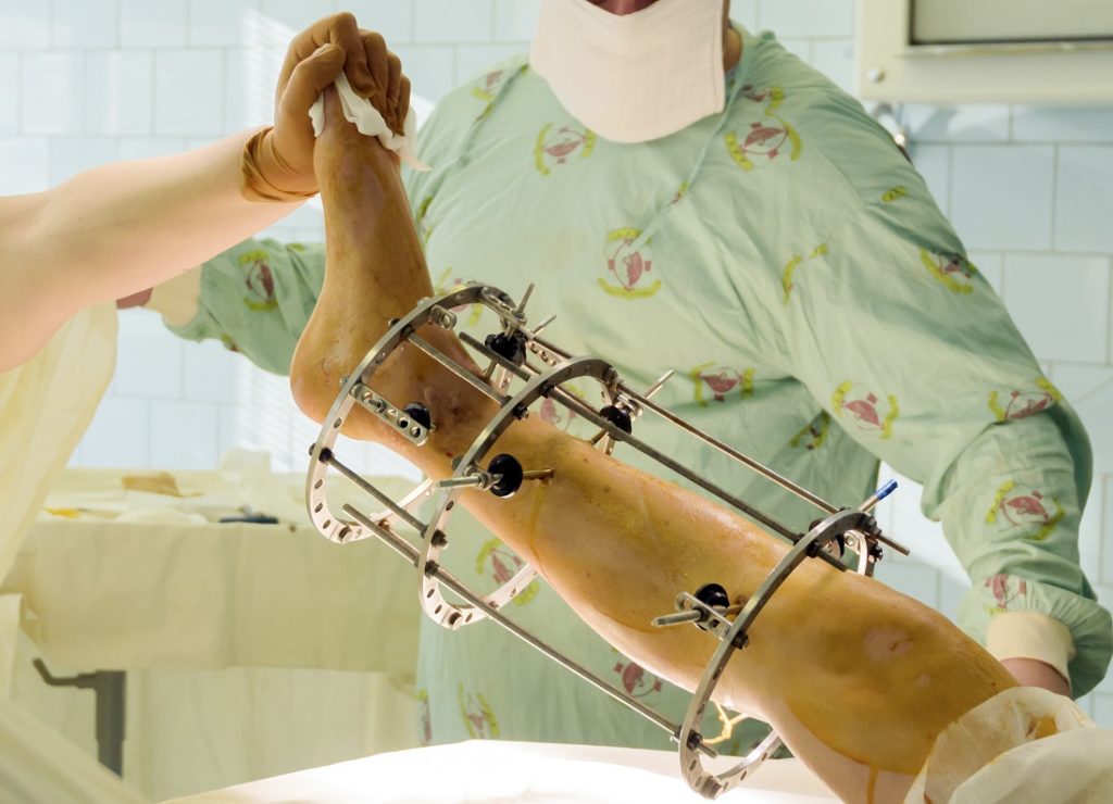 Unequal limb length discrepancy surgery & treatment