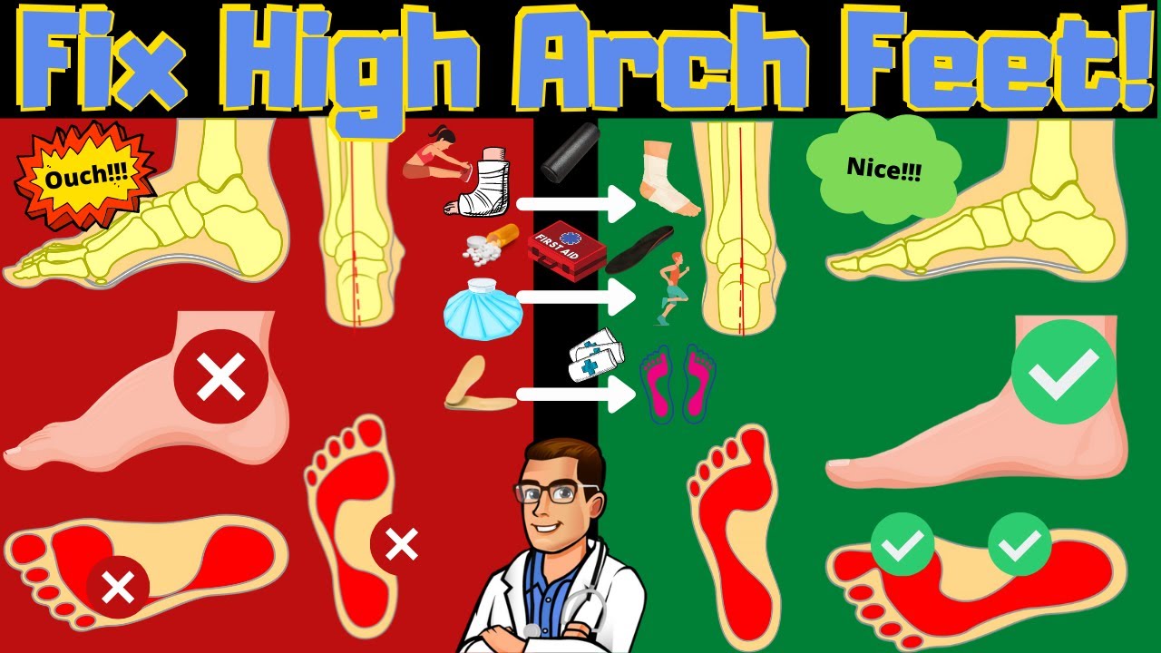 FIX High Arches & High Arch Feet [Supination & Pes Cavus Foot Type] -