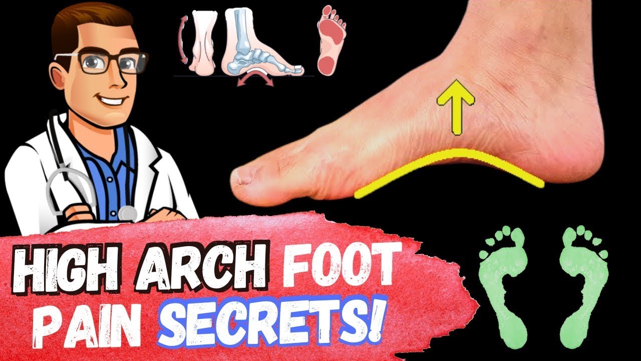 high arch feet