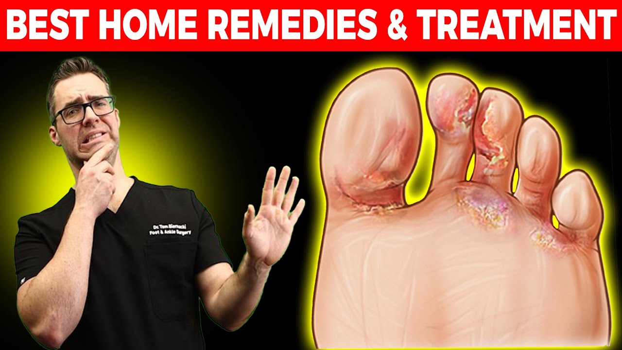 how to stop itchy feet