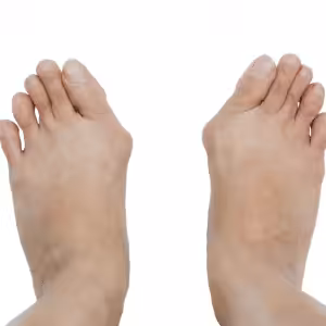 pinky toe bunion