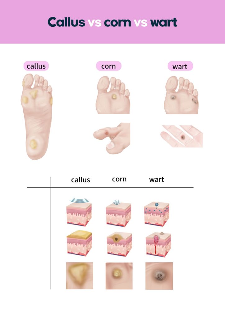 Yellow feet corn vs wart vs callus