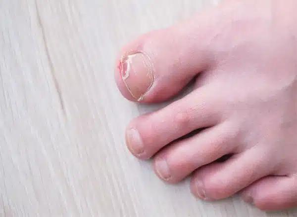 Close-up of a broken and cracked big toenail resulting from a traumatic injury, illustrating a common foot condition tha
