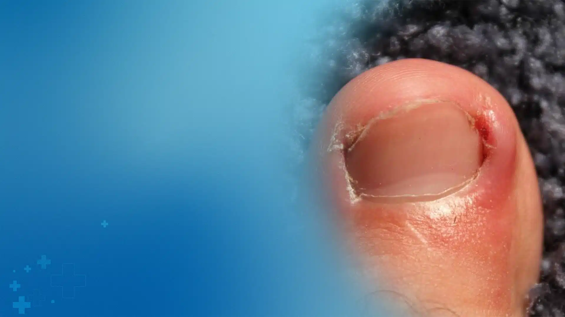 Inflamed And Painful Ingrown Toenail Illustrating A Condition Requiring Specialist Podiatric Care To Treat Infection And Provide Permanent Relief - Balance Foot & Ankle