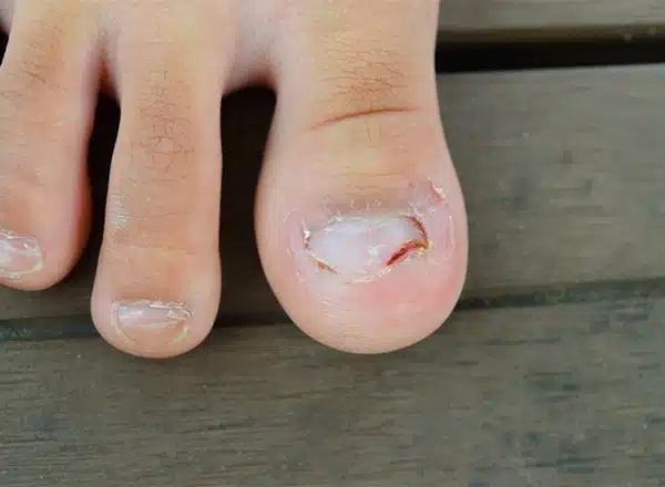 Top-down close-up of a big toe experiencing onycholysis, where the toenail is peeling away from the nail bed due to a fungal infection or injury, requiring clinical podiatric assessment.