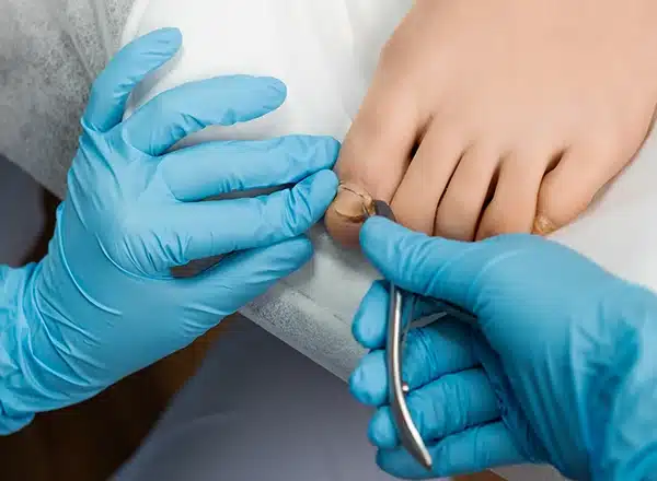 A podiatrist wearing blue medical gloves uses professional nippers to carefully treat an ingrown toenail, providing a clinical solution for pain relief and proper nail realignment.