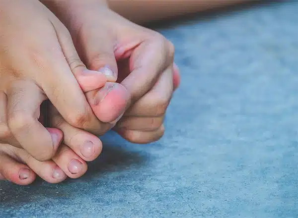 Close-up of hands examining a big toe with a horizontal crack or fissure in the nail, illustrating a nail injury or fungal condition that requires expert podiatric care.