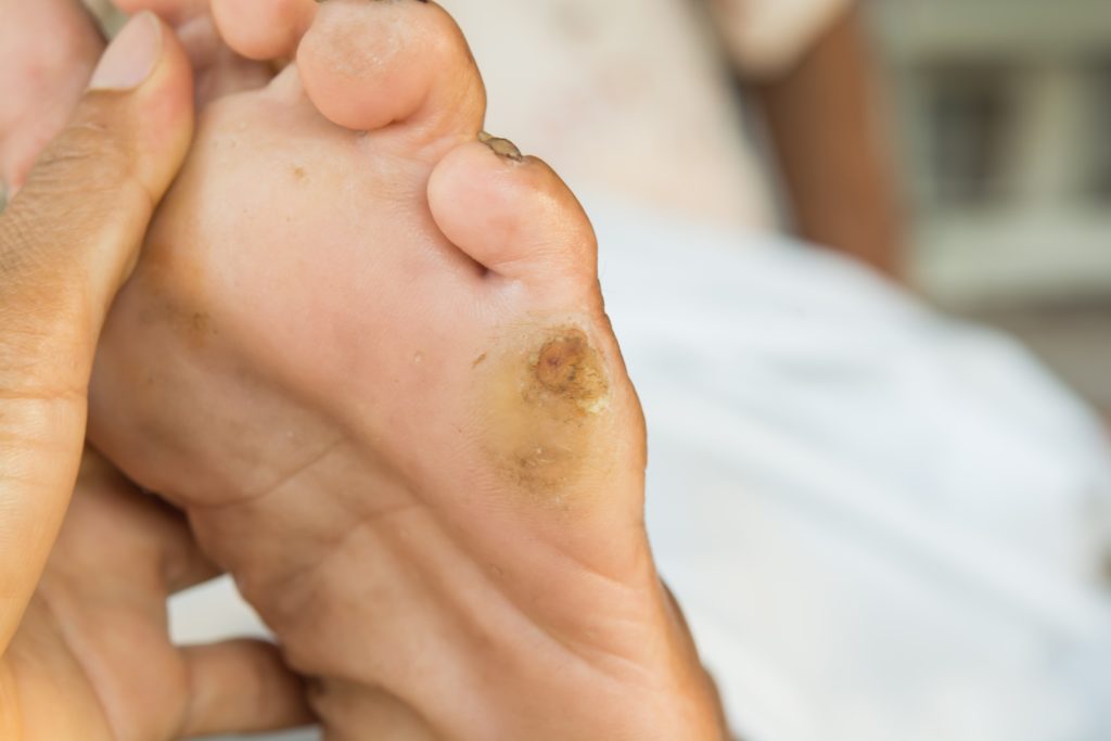 how do podiatrists remove corns