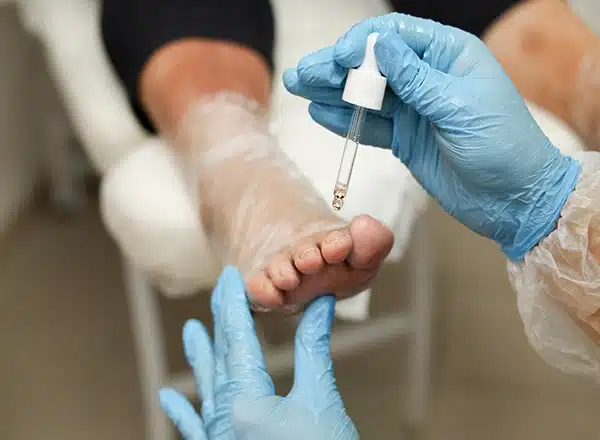 A healthcare professional wearing blue gloves uses a glass dropper to apply a clear medicinal liquid to a patient's toenails during a fungal treatment procedure.