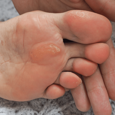 corn removal near me