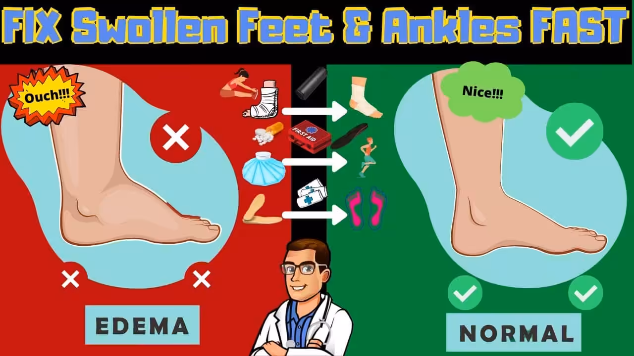 Edema 9 Swollen Feet Swollen Ankles Swollen Legs Fix Them Fast 2 - Balance Foot & Ankle