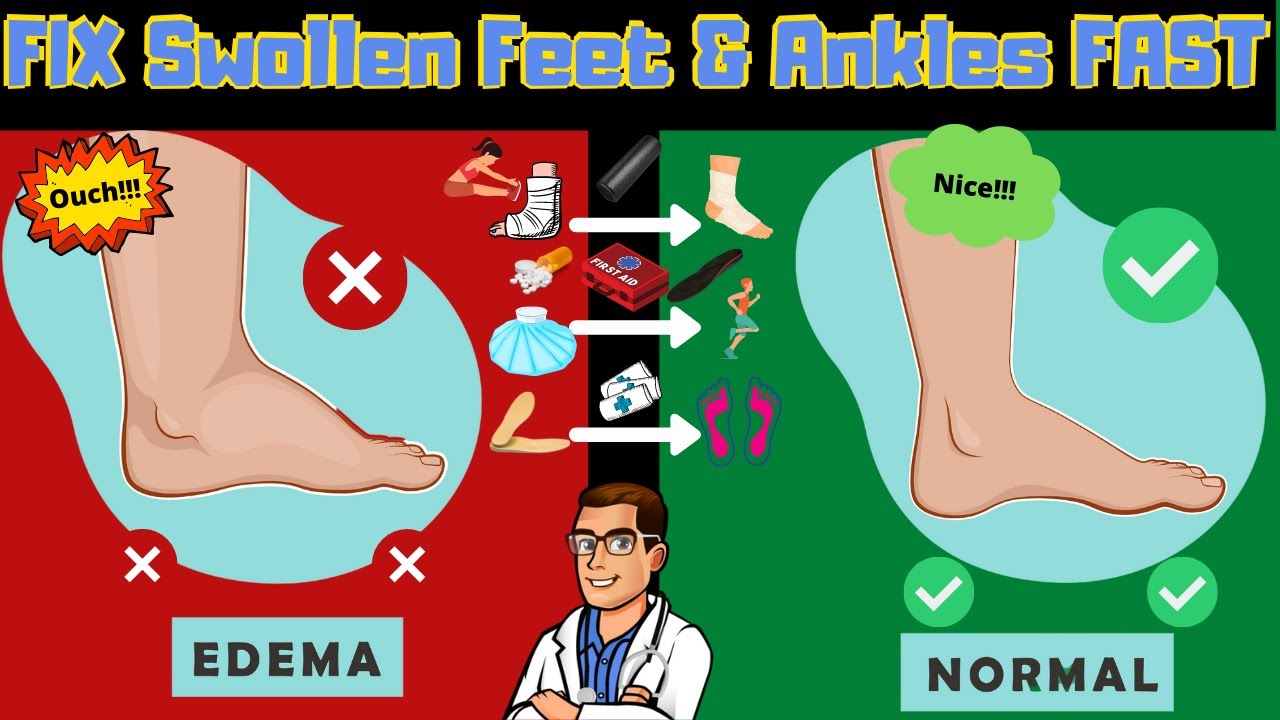 edema 9 swollen feet swollen ankles swollen legs fix them fast