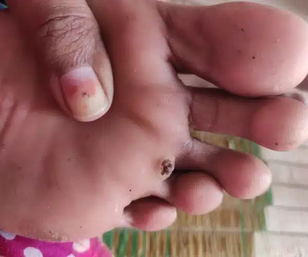 how to remove a corn from your foot