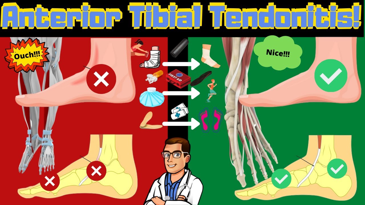 tibialis anterior tendonitis tendonitis on top of foot treatment