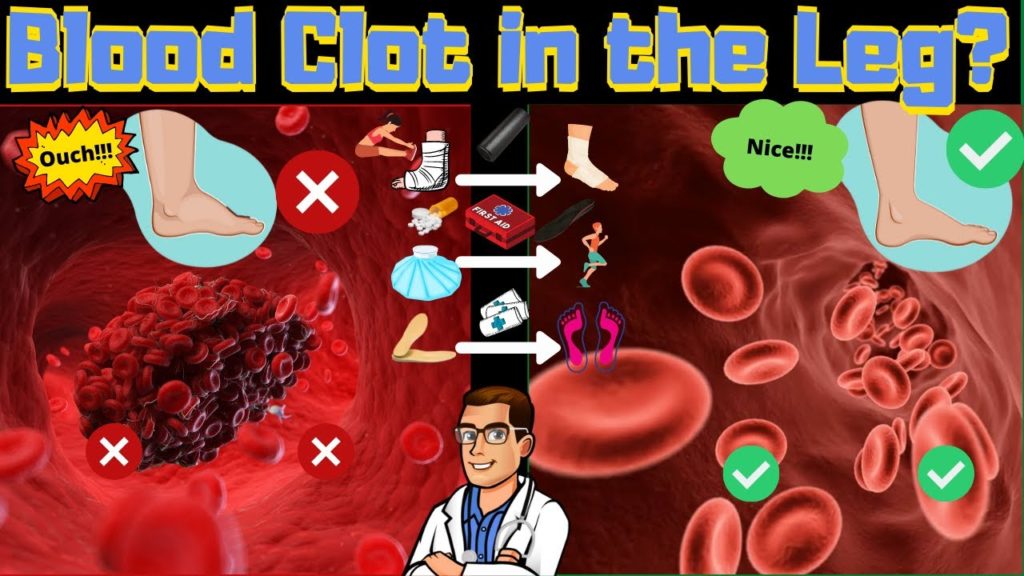 Blood clot in the foot, blood clot in the leg