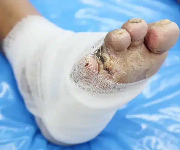 diabetic foot treatment