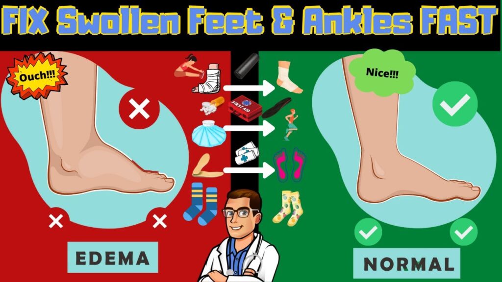 Lymphedema Treatment [How to Get Rid of Swollen Feet, Ankles & Legs]