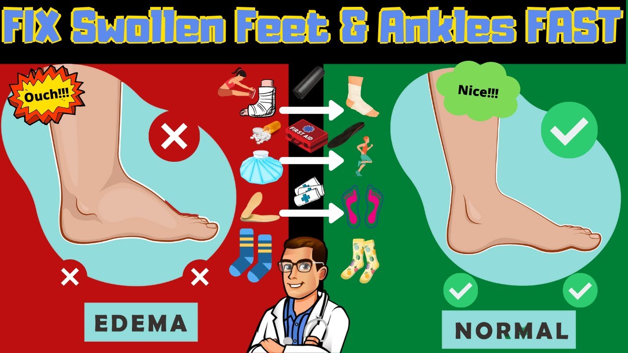 lymphedema treatment how to get rid of swollen feet ankles legs