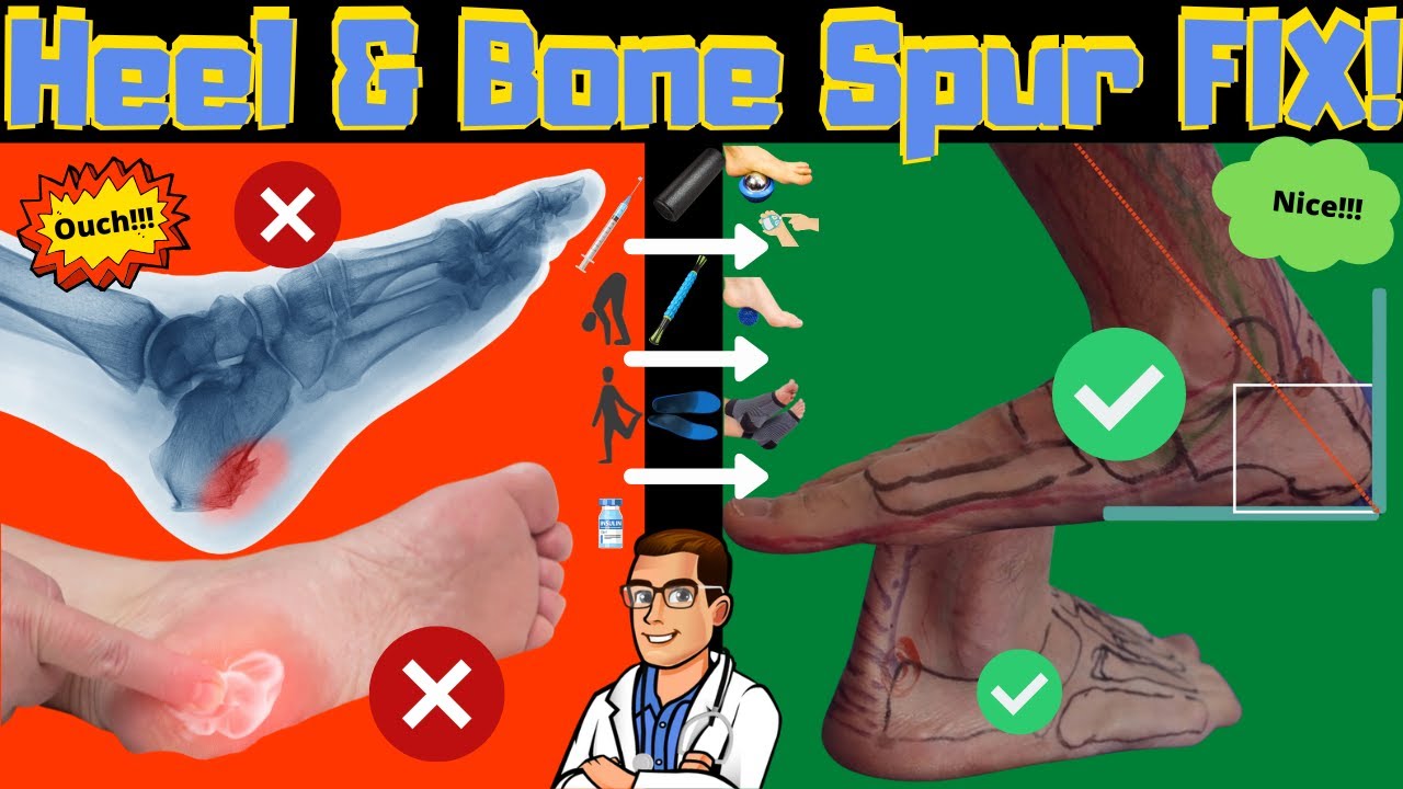 calcaneal bone spurs in foot heel spur treatment