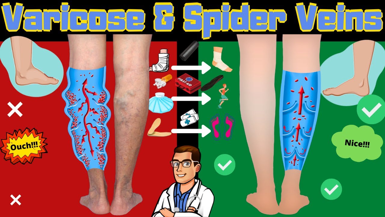 spider veins in legs varicose veins treatment causes symptoms