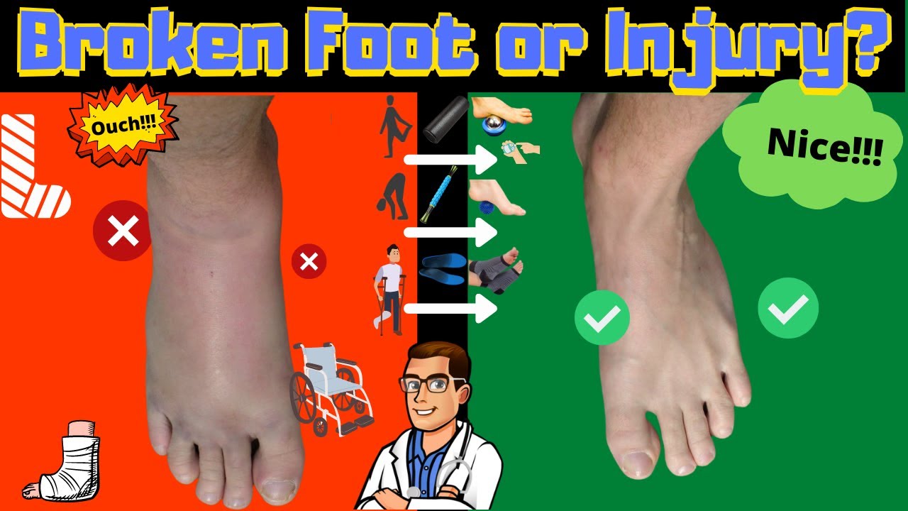 17 must do tips broken foot or toe foot sprain stress fracture