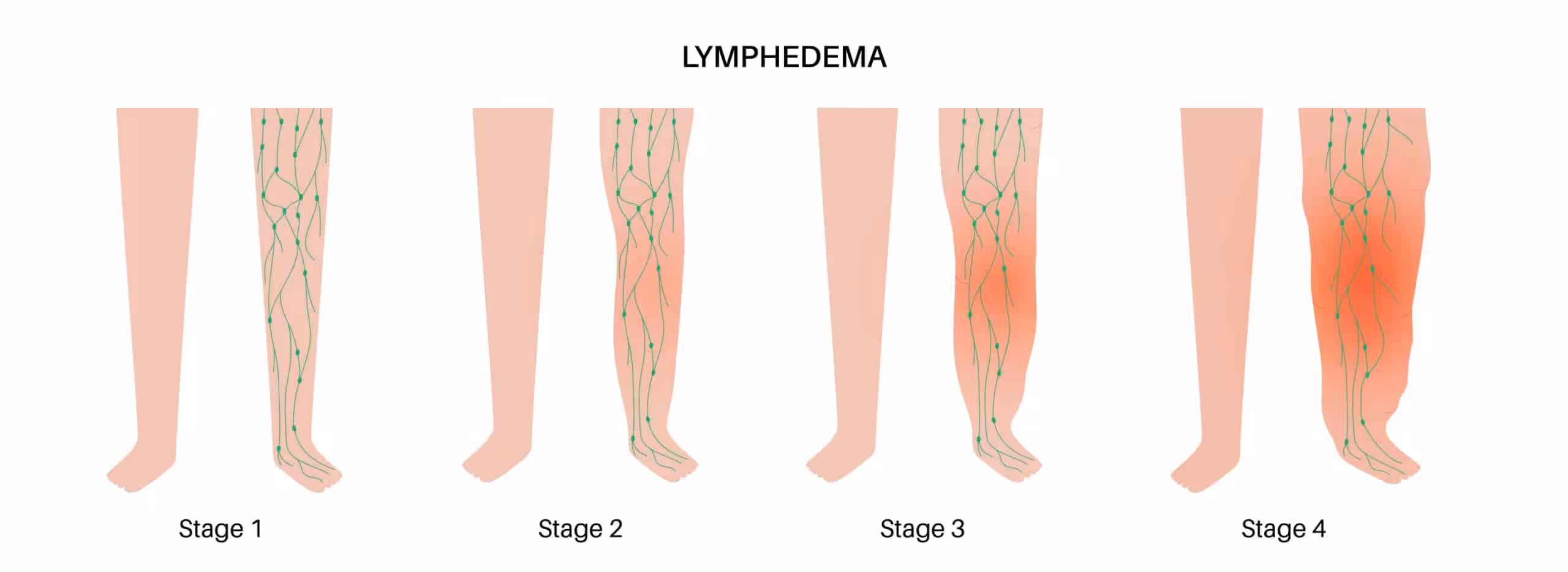 Stages Of Lymphedema | Balance Foot & Ankle