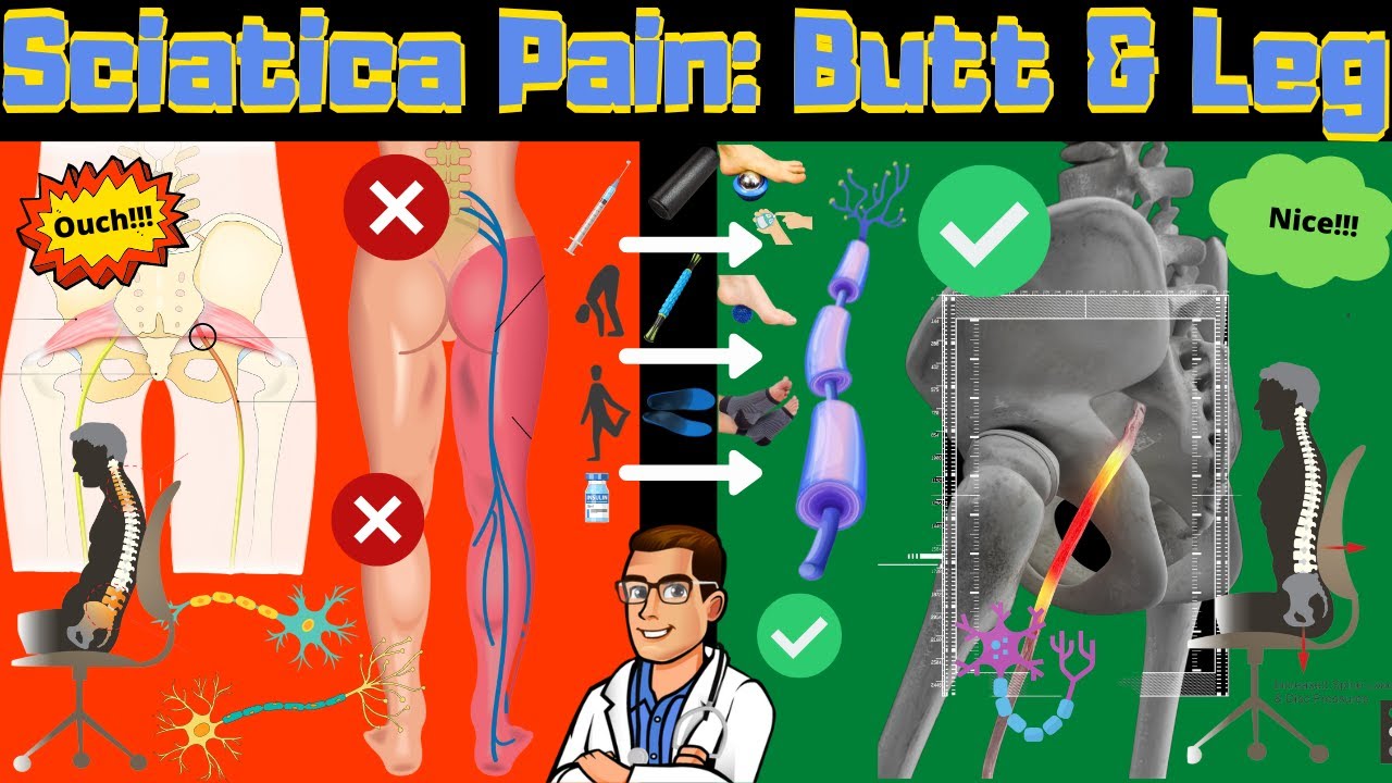 how to cure sciatica permanently treatment stretches