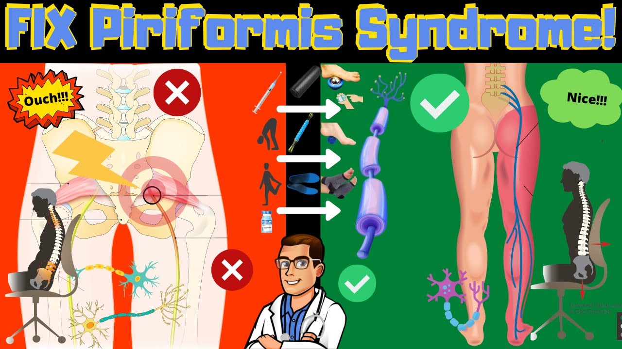 piriformis syndrome won t go away stretches i exercises i treatment