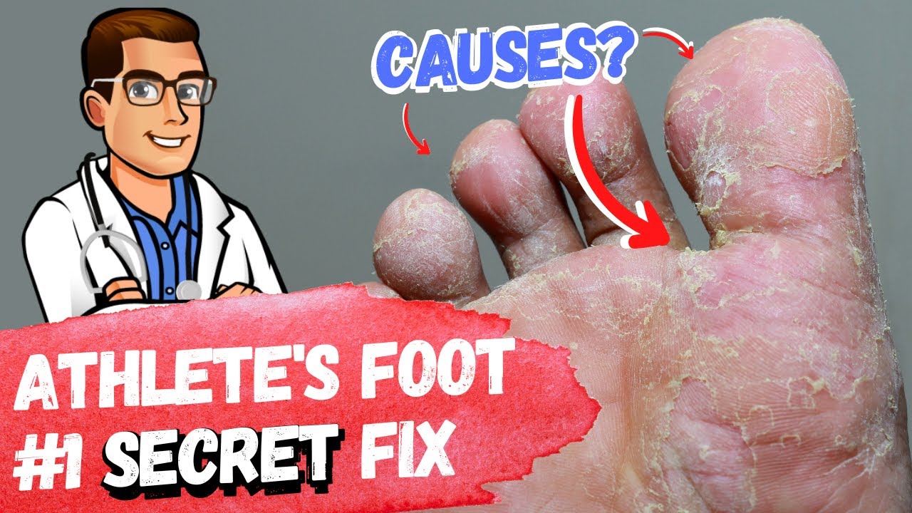 best 9 athlete s foot fungus remedies the 1 big mistake avoid