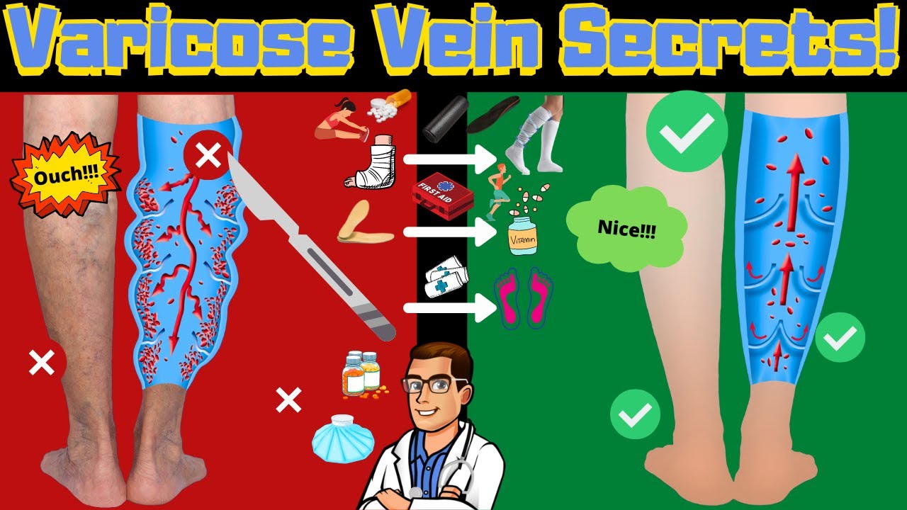 best varicose veins home treatments top 25 spider veins remedies
