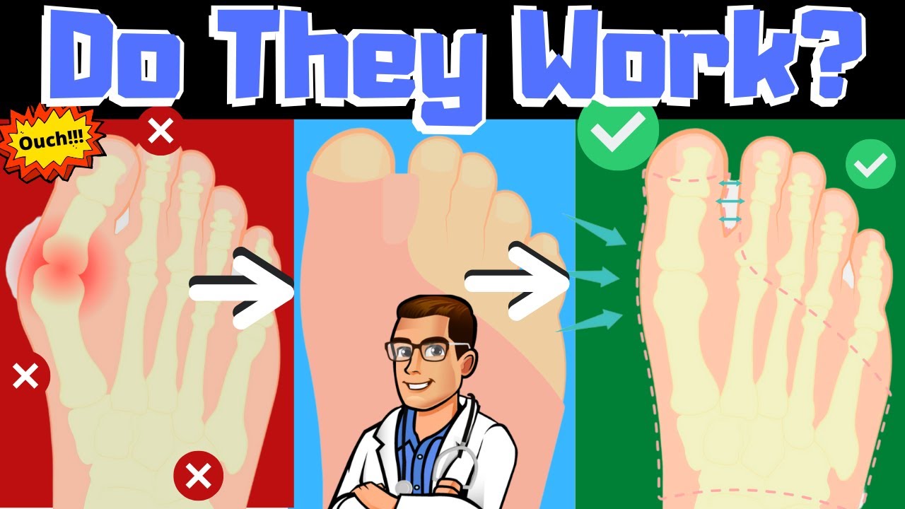 do bunion correctors work how to shrink bunions naturally