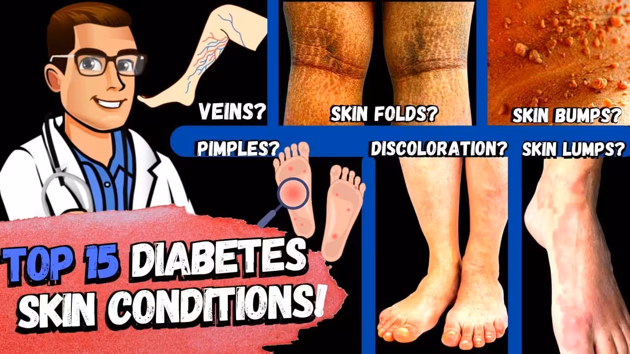 Top 15 Diabetes Skin Signs & Symptoms [Type 2 & 1 Diabetes Mellitus] | Balance Foot & Ankle