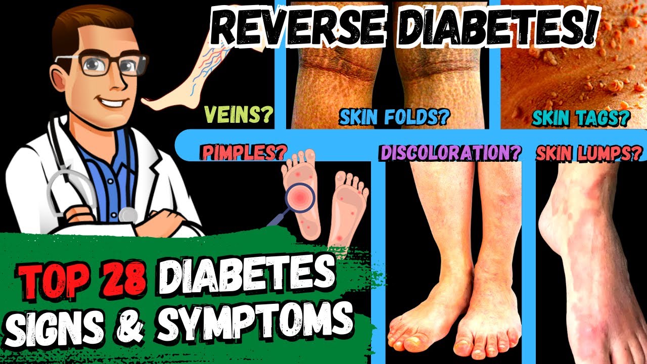 28 diabetes signs symptoms reverse diabetes 2 big secrets