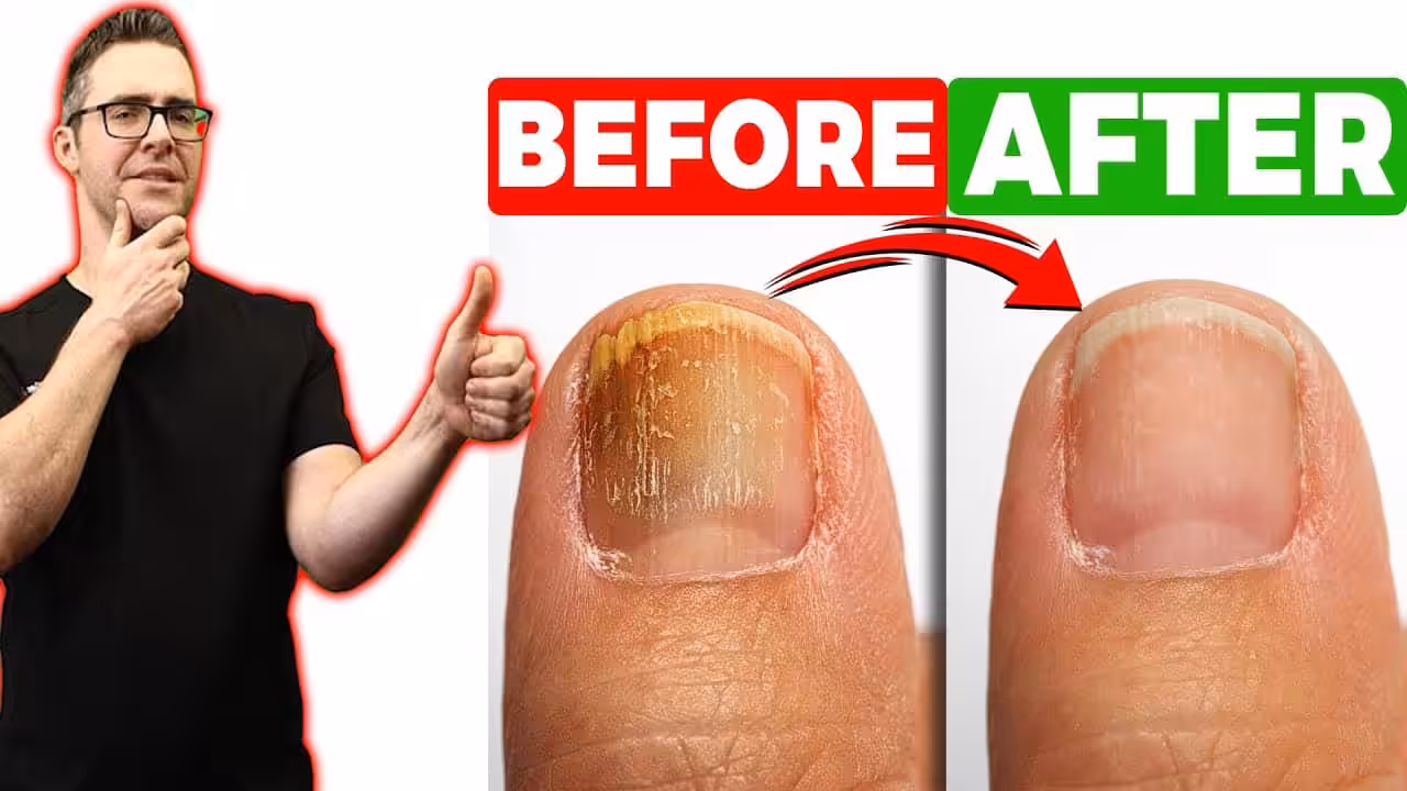 best over the counter toenail fungus treatment