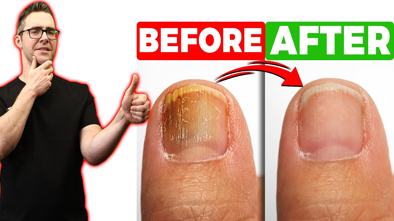 best over the counter toenail fungus treatment