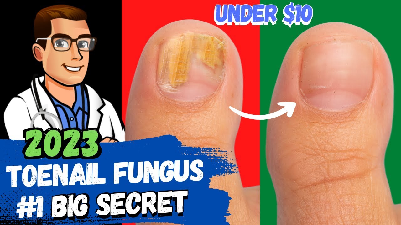 best toe nail fungus treatment 2023 4 big secrets