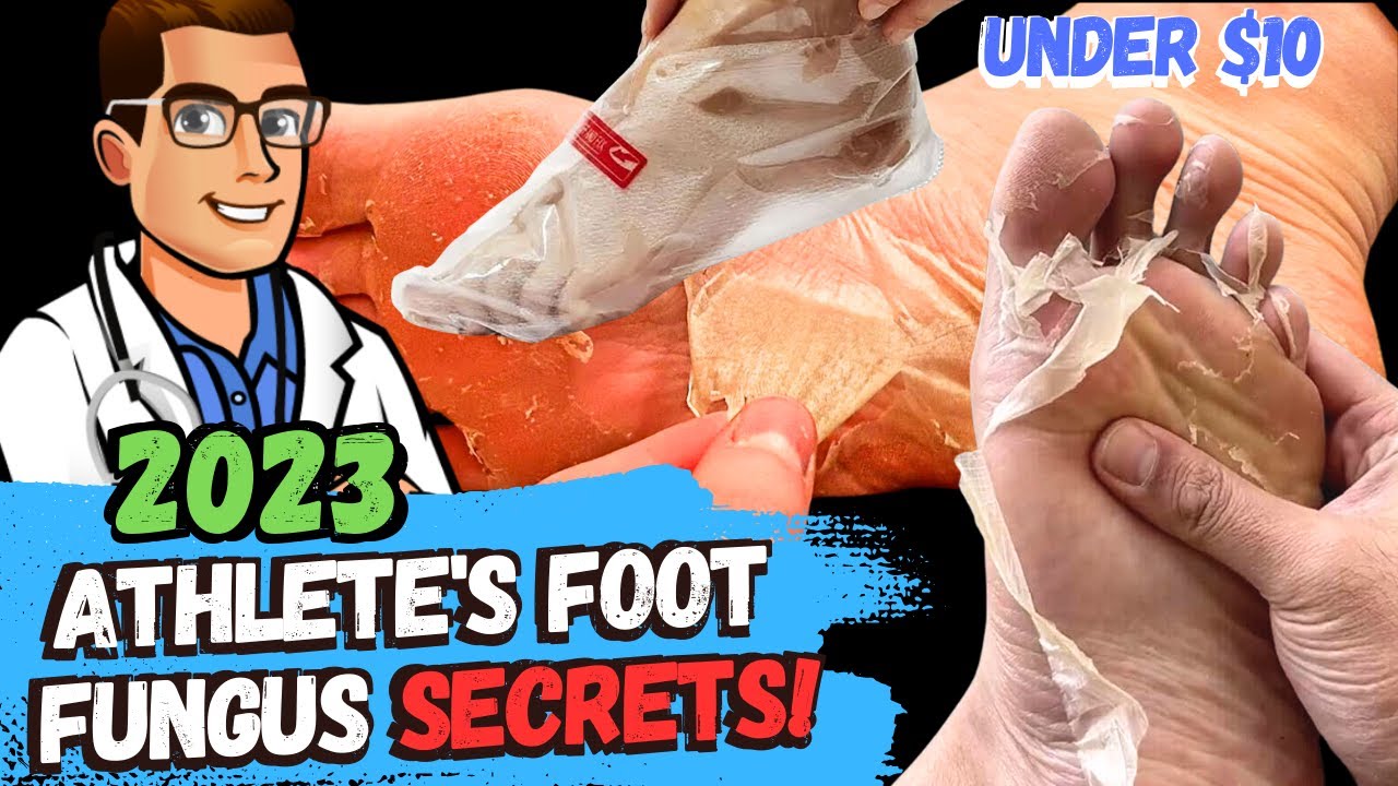 how to cure athletes foot fungus fast home remedies 3 big secrets