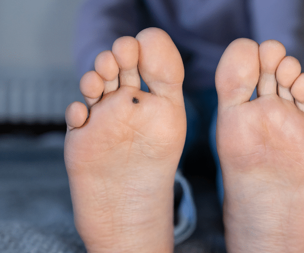 plantar wart with Cantharidin