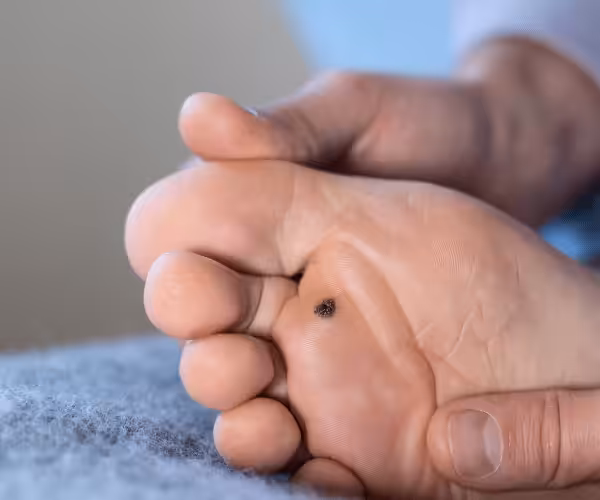 plantar wart removal near you with Salicylic Acid​