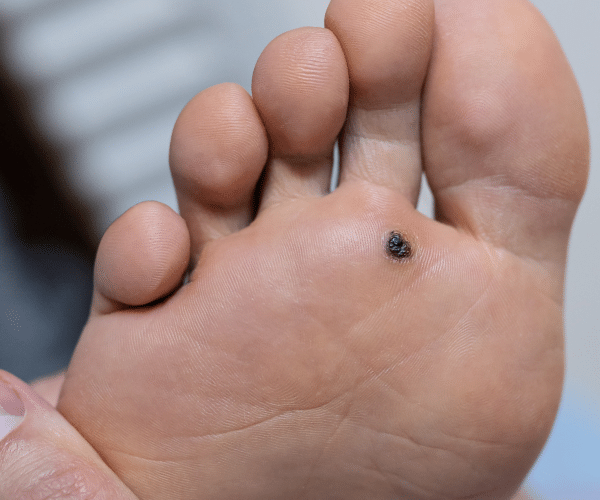 plantar wart removal with Imiquimod
