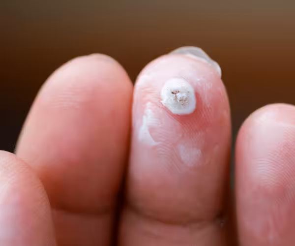 plantar wart removal with Podophyllotoxin