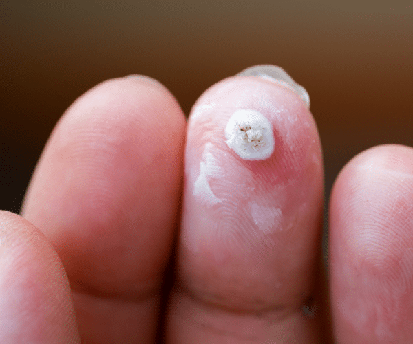 plantar wart removal with Podophyllotoxin